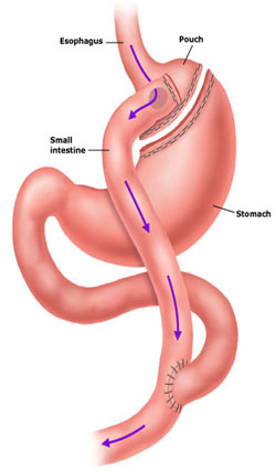 roux en y gastric bypass before after