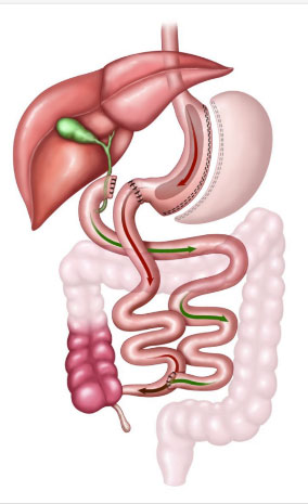 Duodenal switch and SADI illustration