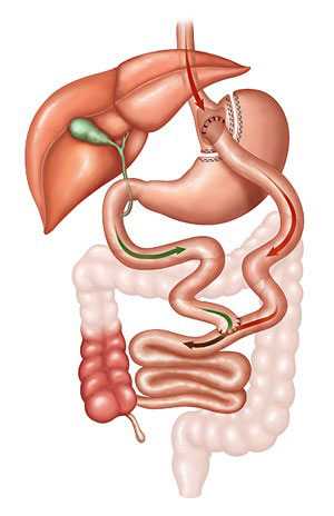 Gastric bypass illustration