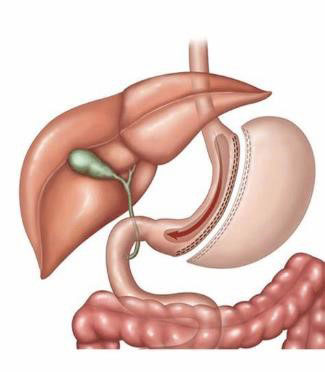 Sleeve gastrectomy illustration